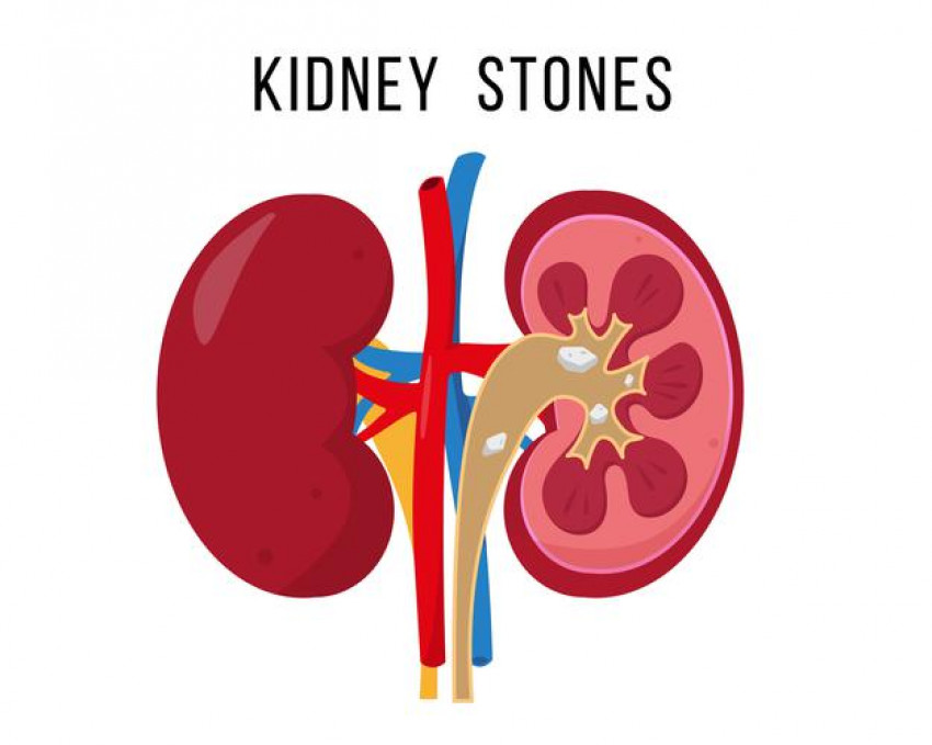 Tips for Ayurvedic kidney stone Treatment