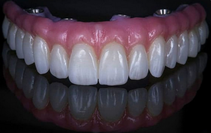 Innovations In dental implants to get good smile