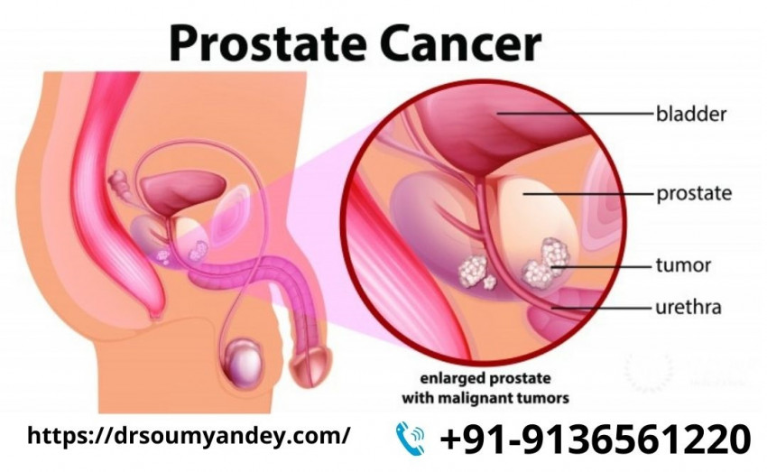 Problem of an Enlarged Prostate Explained by Dr Soumyan Dey