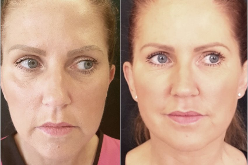 What are the Benefits of Profhilo Treatments?