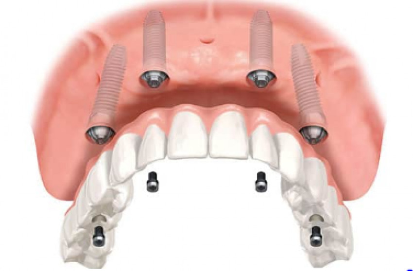 Get your hassle-free smile today with dental implants Langhorne PA