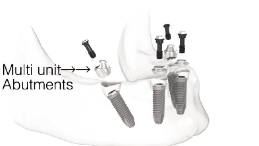 Smile! The benefits of dental implants