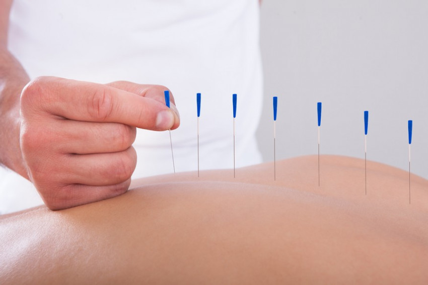 Exclusive Things to Notice About Acupuncture Therapy