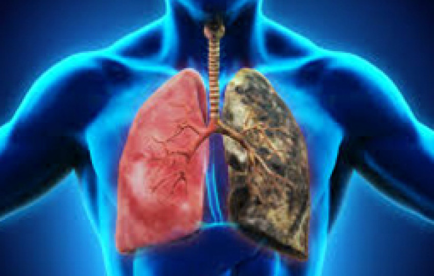 Lung cancer treatment in India