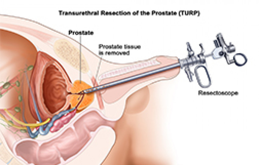 Best TURP Surgery Cost in India