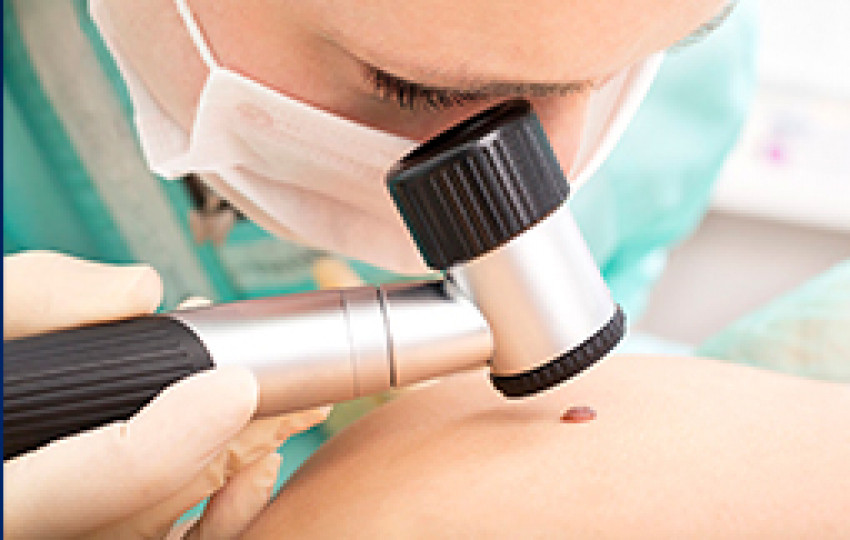 Skin Cancer Treatment in India