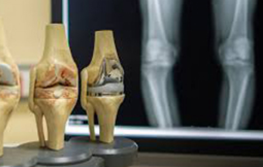Knee replacement surgery cost in India