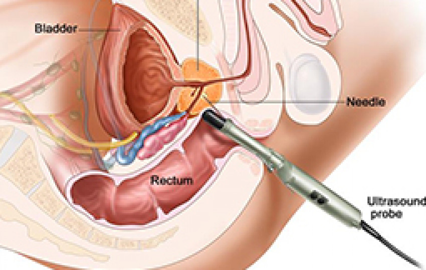 Prostate Cancer Treatment in India
