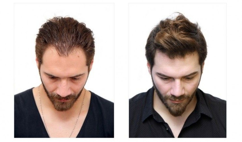 Best Clinic for Hair Transplant