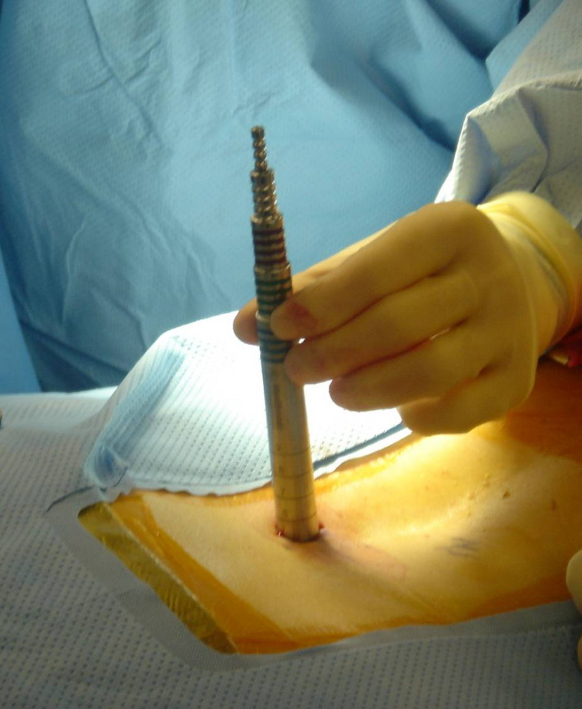 Deciding upon The ideal Spine Surgeon