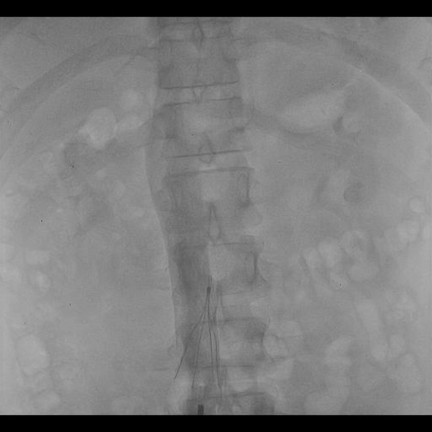 What is Fistuloplasty? Why Do You Need This Treatment?