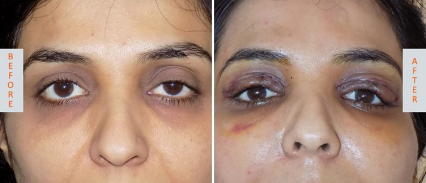 Eyelid Surgery Procedure In India