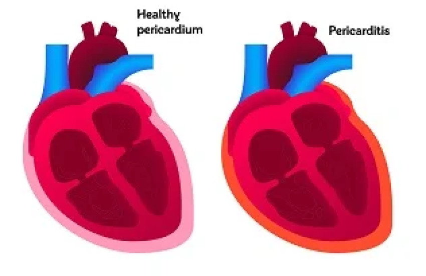 Pericarditis Market Size, Epidemiology, Analysis & Trends 2023-2033