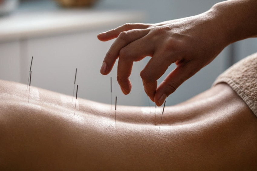 Discovering Acupuncture: Your Guide to Treatment Options in Dubai