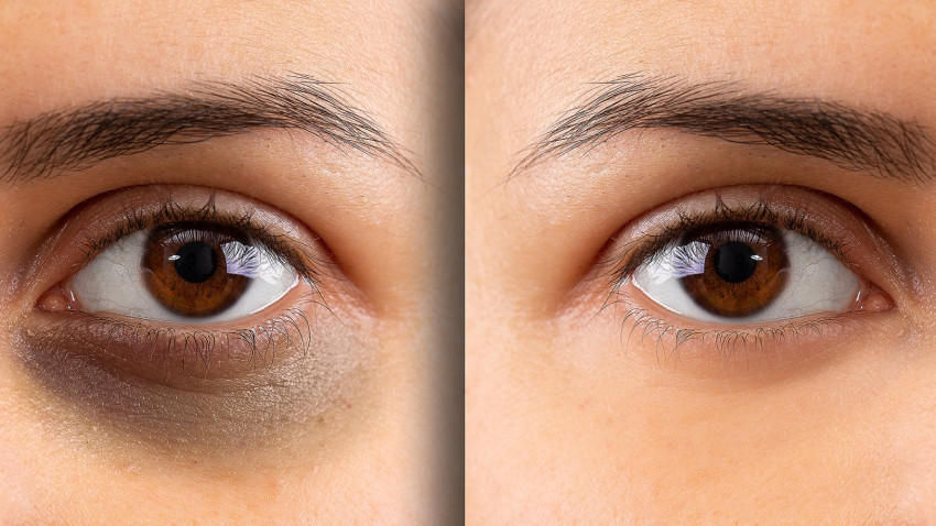 Revitalize Your Skin: Dark Circles Treatment at Birmingham's Premier Skin Clinic