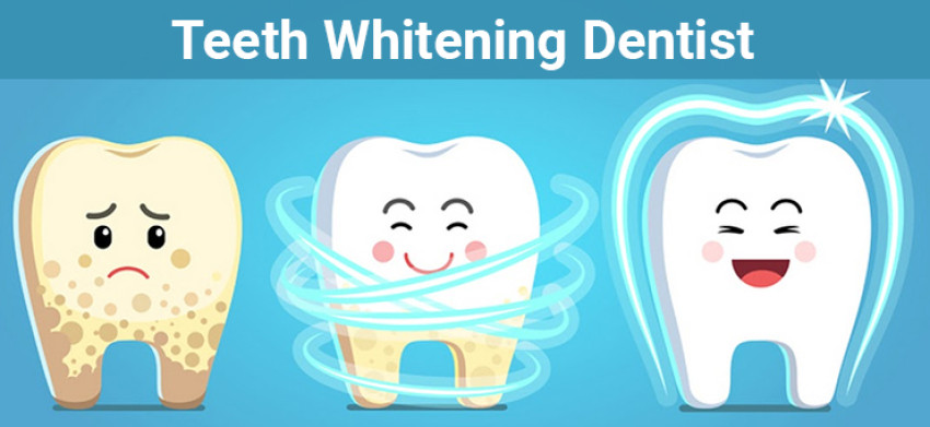 Things to know before getting a teeth whitening treatment