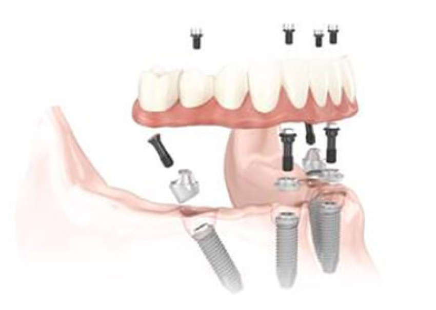 Dental Implants in Ahmedabad by Internationally Trained Dental Professionals