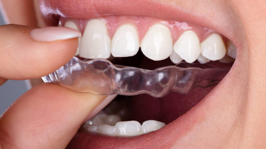 Getting Started with Invisalign in Calgary: What to Expect