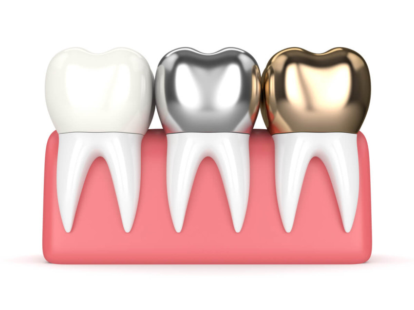 Understanding Dental Crowns: When and Why They're Needed in Dearborn