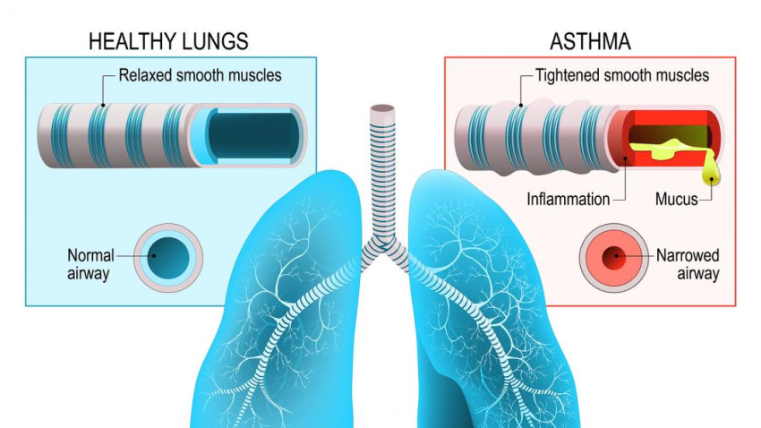 Unraveling the Asthma Enigma: Exploring the Potential Autoimmune Connection