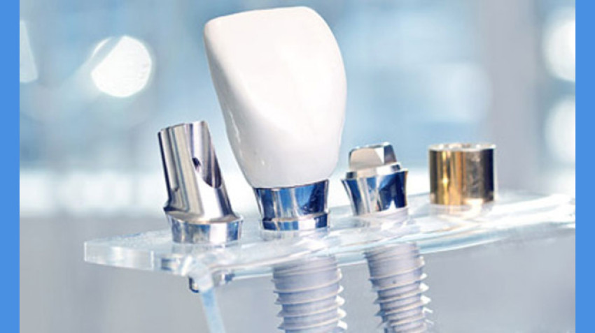 Dental Implants in Vijayawada-Top Dental Implant Clinic