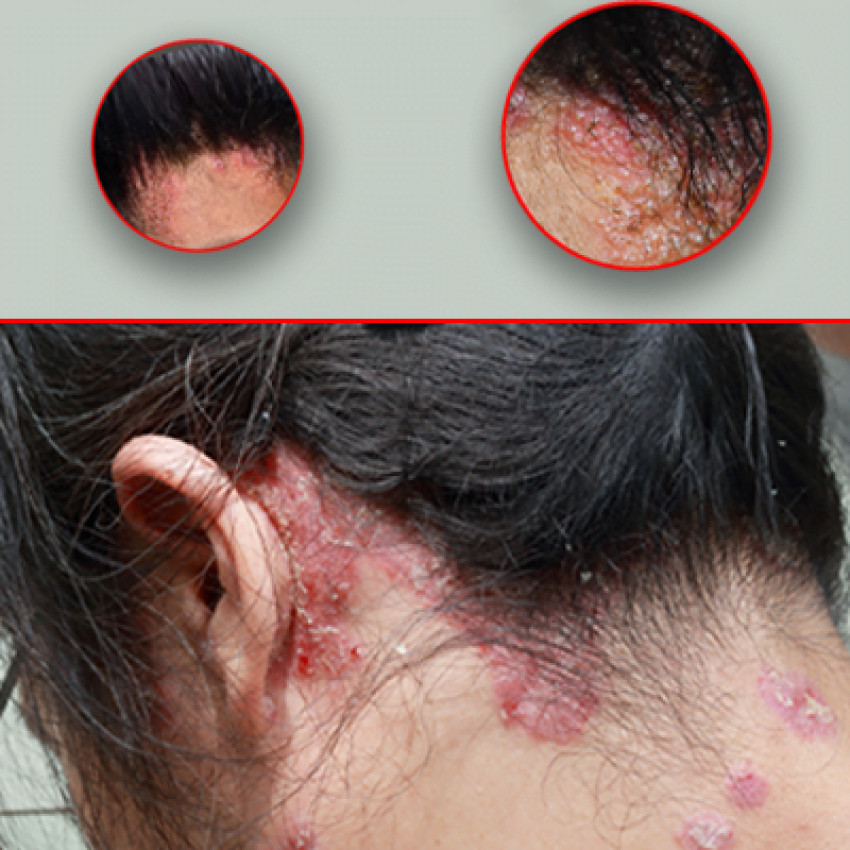 Psoriasis treatment by homeopathy