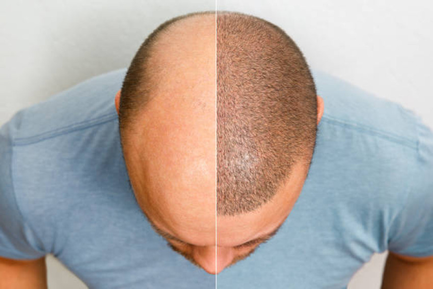 Unlocking Confidence: A Definitive Guide to Optimal Hair Transplants in Karachi