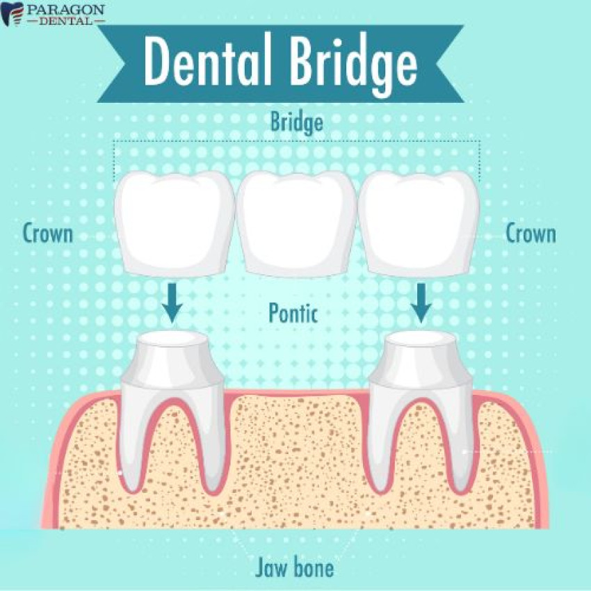 Paragon Dental :    What Are Bridges and Crowns?