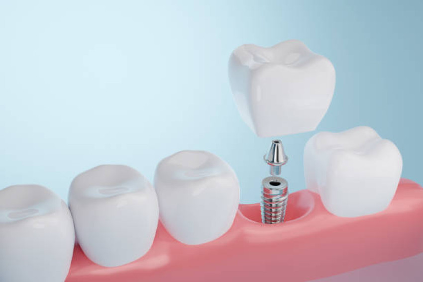 Dental Implants Procedure: Types, Costs, and Insights from HASH CLINICS