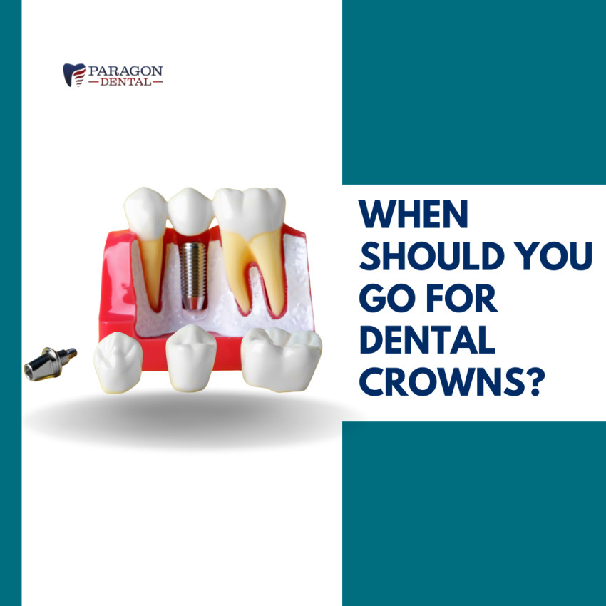 When Is It Time to Get Dental Crowns?
