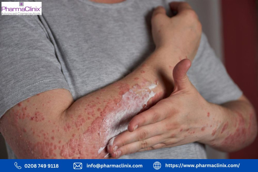 Conquer Post-Inflammatory Hyperpigmentation in Eczema: Unlock the Secrets to Clearer Skin