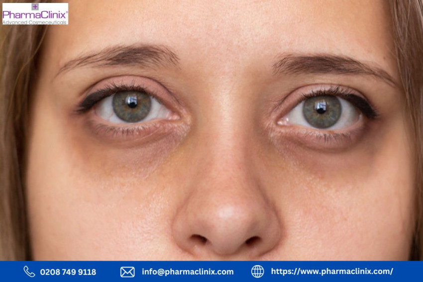 Hyperpigmentation Around Eyes: Causes, Treatment, and Prevention Tips