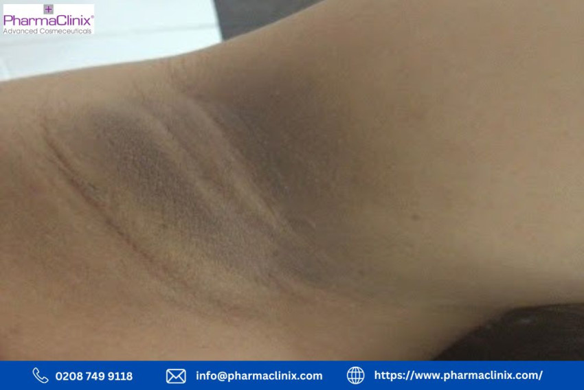 The Battle of Dark Patches in Armpits: A Guide to Conquer Them