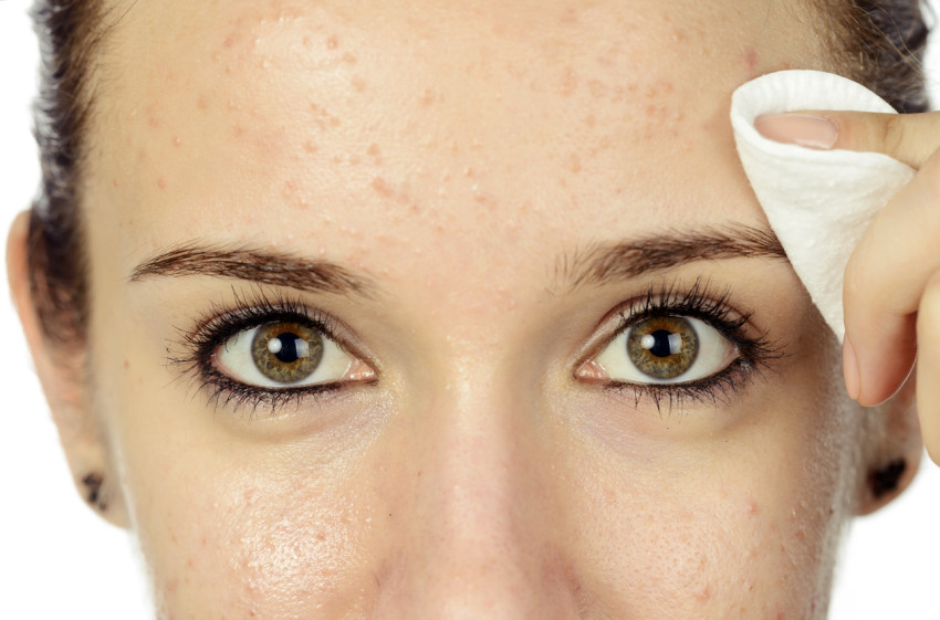 Best Oily Skin Treatment in Hyderabad