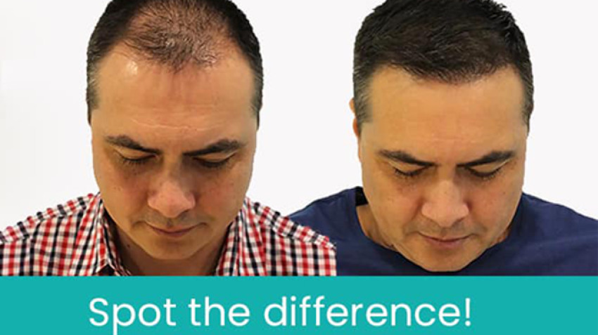 DHI Hair Transplant: Procedure, how it Works, Cost and Benefits