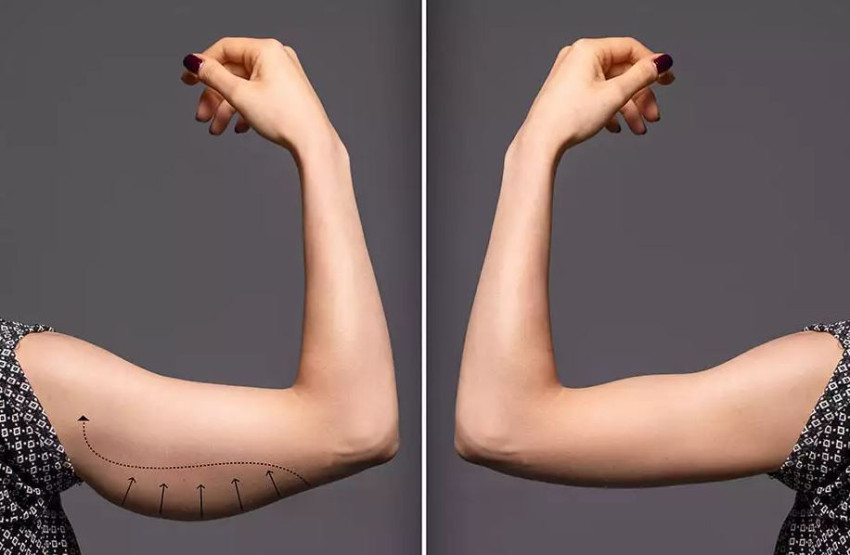 Tone Your Way to Confidence with Arm Lift Surgery