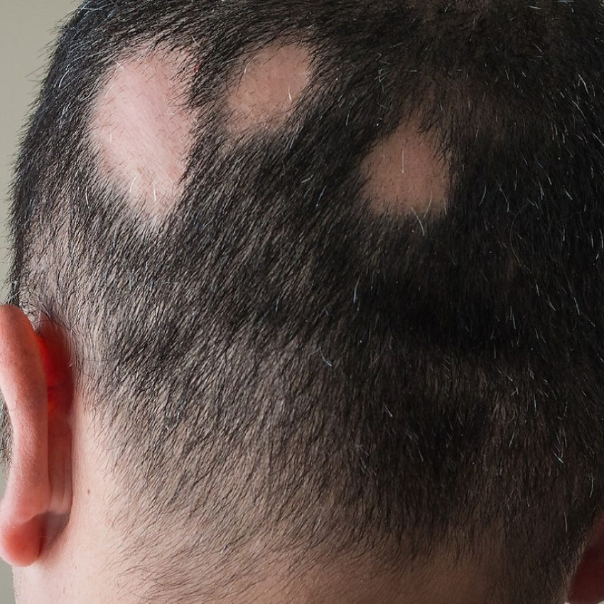 Menopause and Hair Loss - Male hair loss gets all the attention