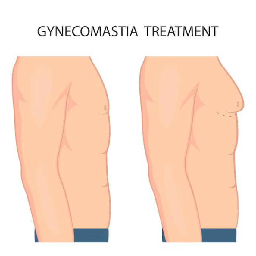 Best Gynecomastia Surgery in Delhi: Achieve Your Desired Result