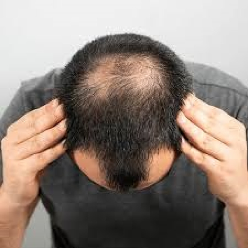 Hair Transplant Dubai: World-Class Services Close to Home