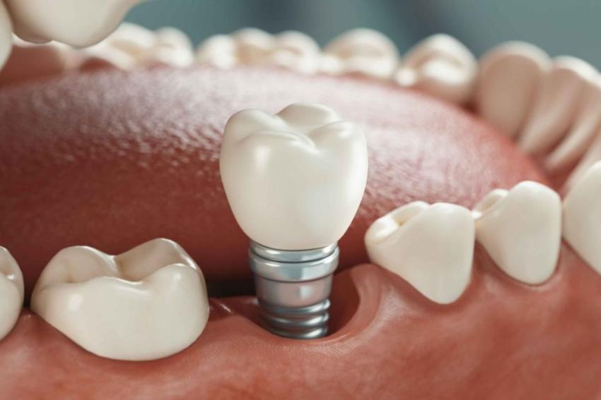 Maintain Dental Implants for lifetime | Pearl Dental Surgery
