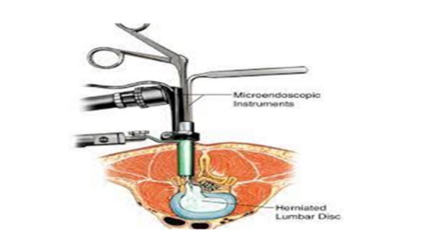 Minimally Invasive Discectomy: A Revolutionary Procedure for Herniated Discs