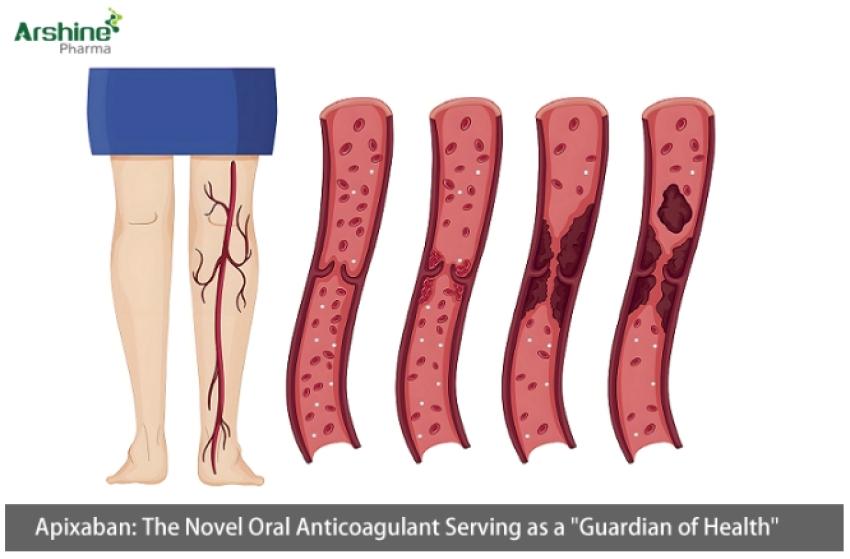 Apixaban: The Novel Oral Anticoagulant Serving as a "Guardian of Health"