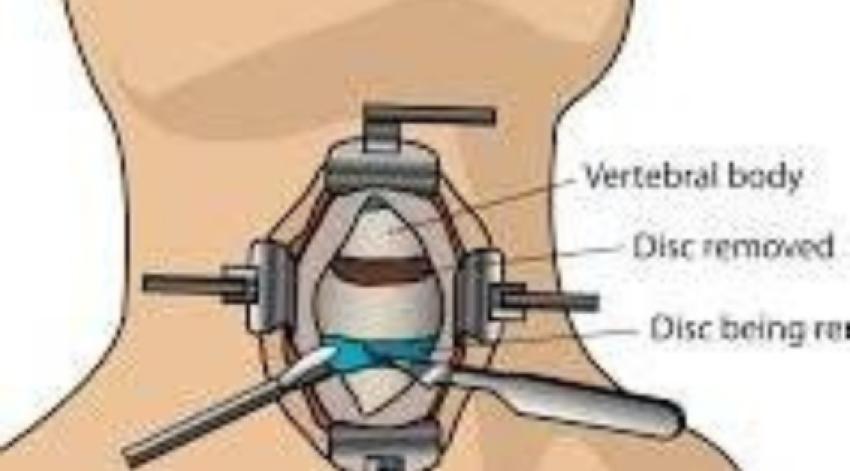 The Importance of Expertise in Cervical Spine Surgery in Kolkata: Why It Matters