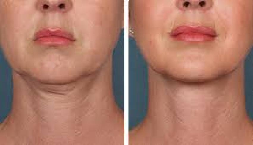 Neck PRP vs. Traditional Neck Treatments: What Your Clients Really Want