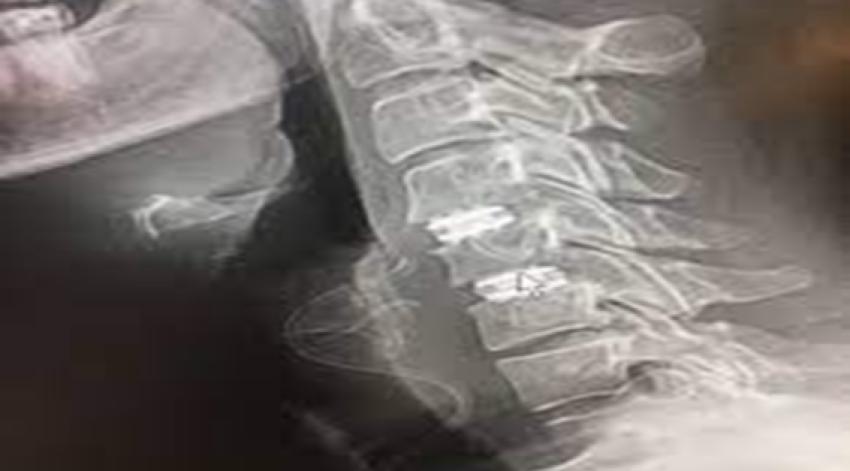 A Guide to Disc Replacement and Cervical Spine Surgery Costs in Kolkata