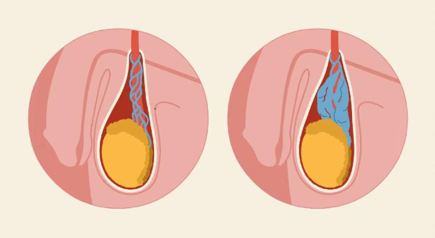 Varicocele Surgery Cost in India | Best Affordable Treatment in Bangalore