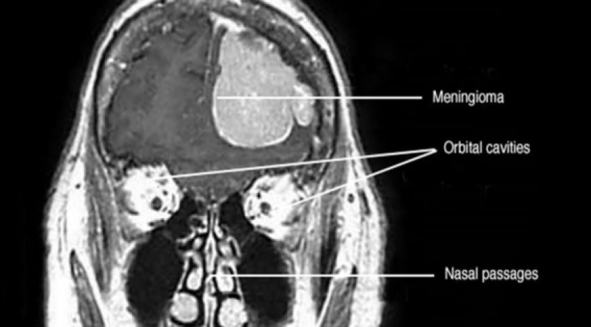 Meningioma Brain Tumor Treatment in Kolkata: A Comprehensive Guide
