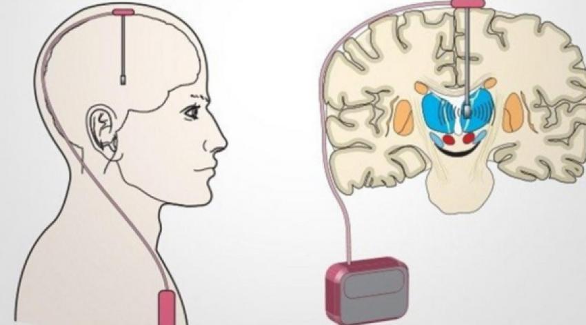 Unlocking Hope: DBS for Advanced Parkinson’s Disease in Kolkata