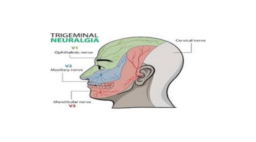 Kolkata's Renowned Neurosurgeons: Pioneering Trigeminal Neuralgia Treatment