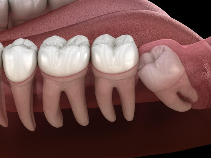 Why Do Wisdom Teeth Grow and Should You Remove It?